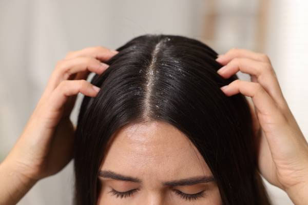 Hair Care | ಕೂದಲಿನ ಅಂದ ಕೆಡಿಸುತ್ತಿದೆಯೇ ಡ್ಯಾಂಡ್ರಫ್? ಈ ನೈಸರ್ಗಿಕ ಟಿಪ್ಸ್ ಫಾಲೋ ಮಾಡಿ